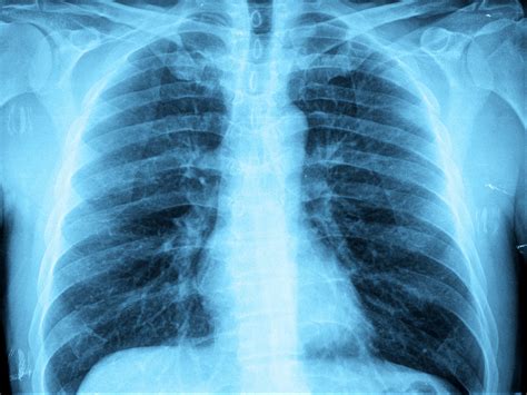 What is 'White Lung Syndrome,' the Ohio child pneumonia outbreak?